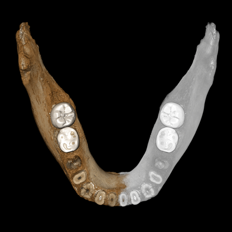 Virtual reconstruction of the mandible, with extrapolated segment shown in grey.